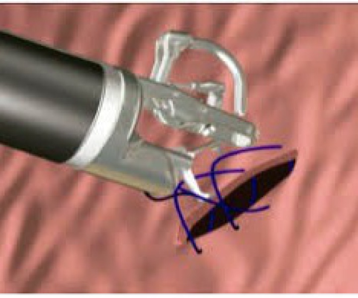 Avances en el Tratamiento Endoscópico de la Hemorragia Digestiva