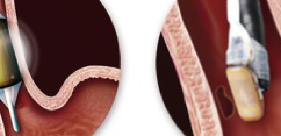 Asenbar: Asociación Española de Enfermos de Esófago de Barret