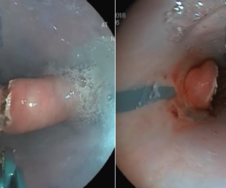 Divertículo de Zenker